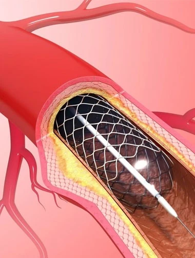 Standard - ISO 5832-6 MP35N Coronary stent implants Standard - ISO 5832-6 MP35N Coronary stent implants